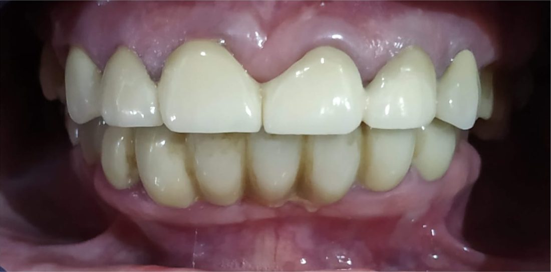 Full Mouth Rehabilitation at Dr. Sapna's Dental Care, Rohtak