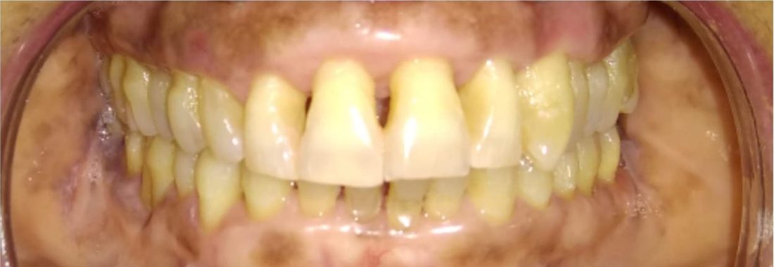 Teeth Cleaning and Polishing in Rohtak: a case treated at Dr. Sapna's Dental Care